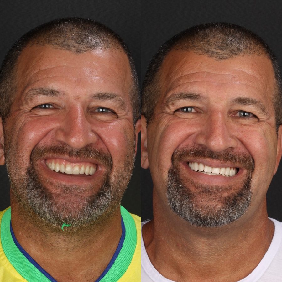 Antes e depois de implante dentário