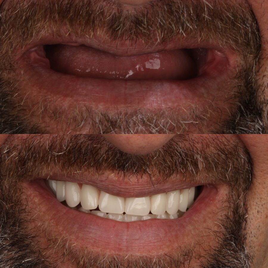 Antes e depois de implante dentário na M.Matos, Presidente Prudente